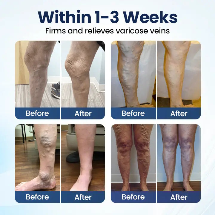 Last Day-Buy 1 Get 1 Free💙Deep Vein Repair Microneedle Patch