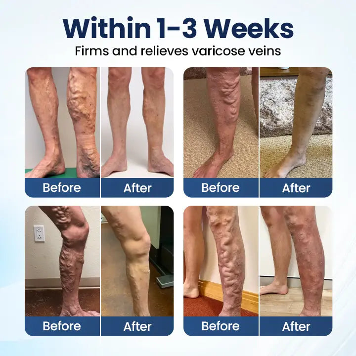 Last Day-Buy 1 Get 1 Free💙Deep Vein Repair Microneedle Patch