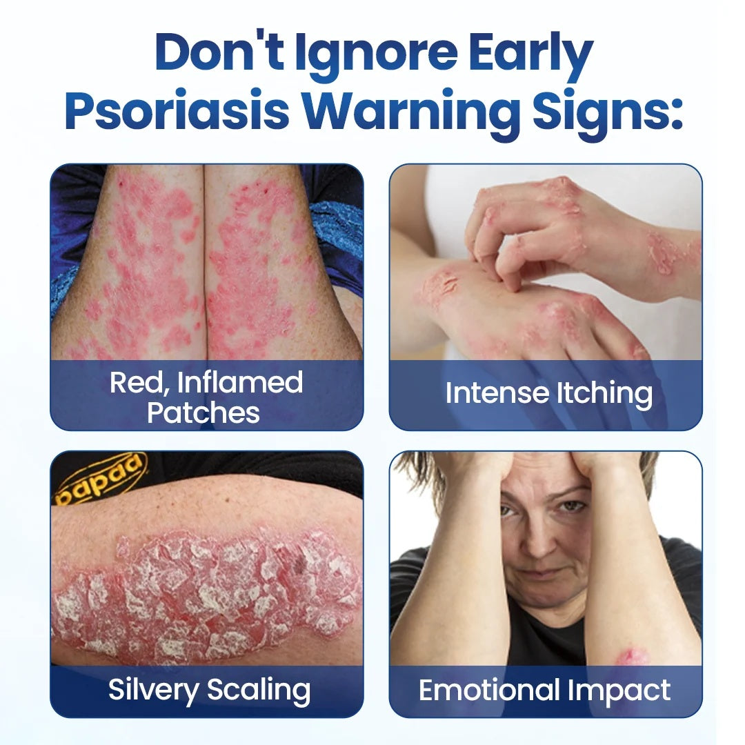 Early psoriasis warning signs