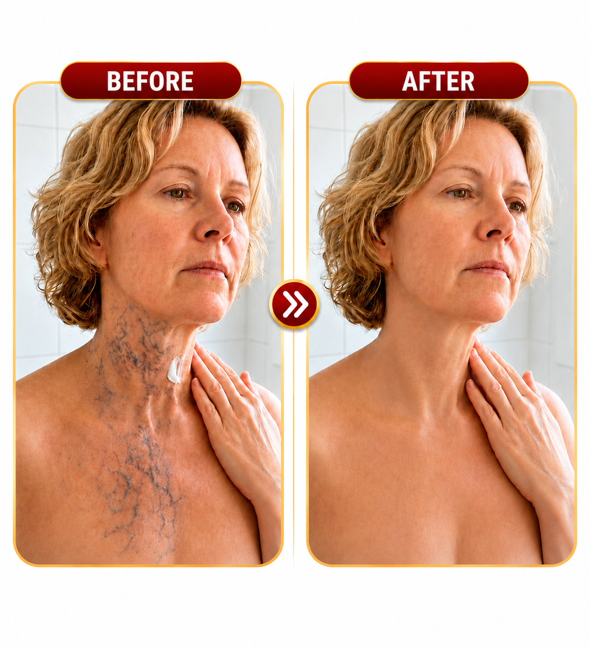 Before and after comparison of visible veins on the neck and upper chest