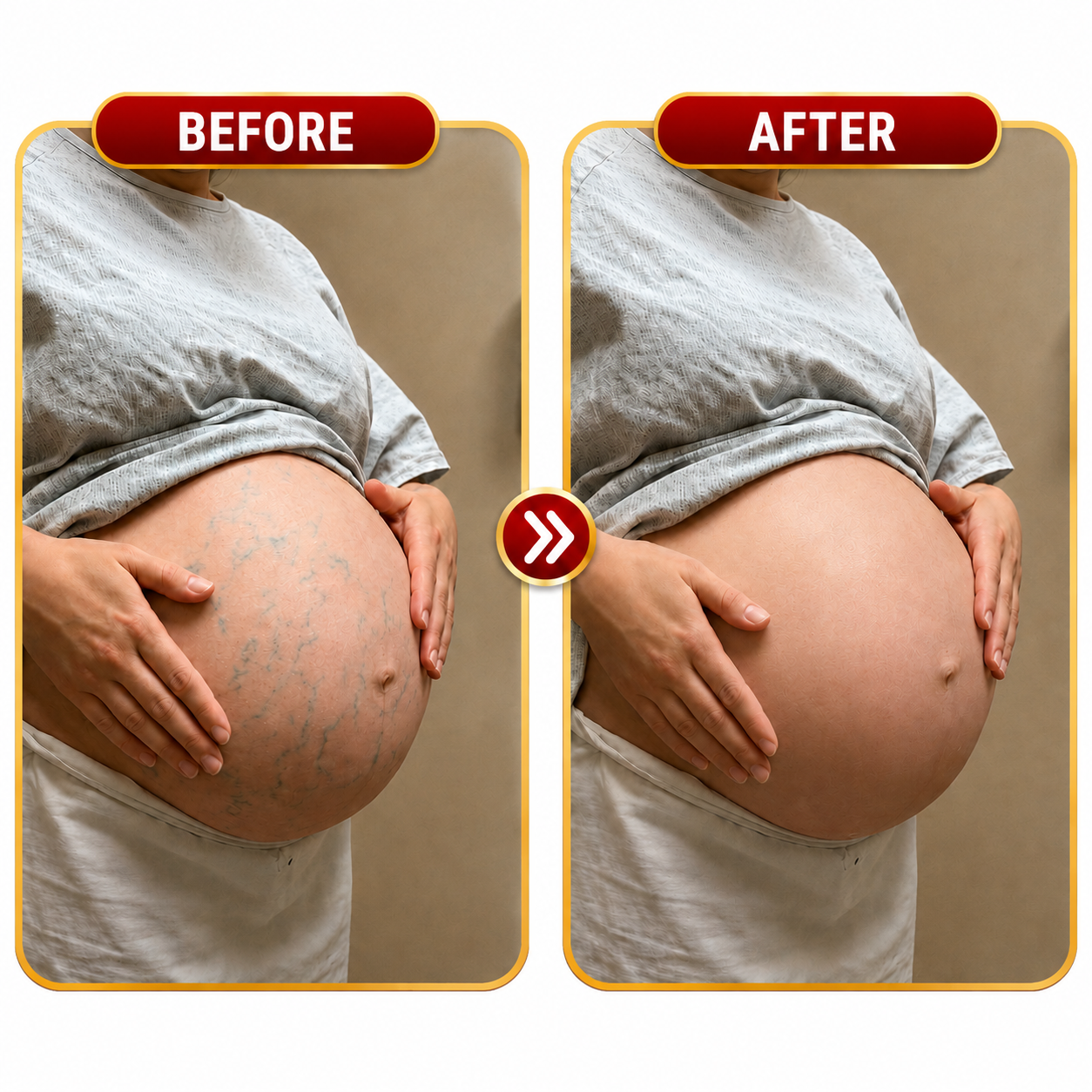 Before and after comparison of visible veins on the abdomen during pregnancy